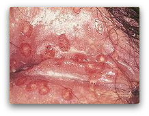 An der scheide herpes Herpes genitalis