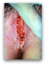 Primary Female Genital Herpes