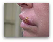 Cold Sore