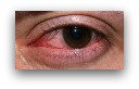 Herpes Keratitis