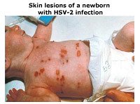 Neonatal Herpes